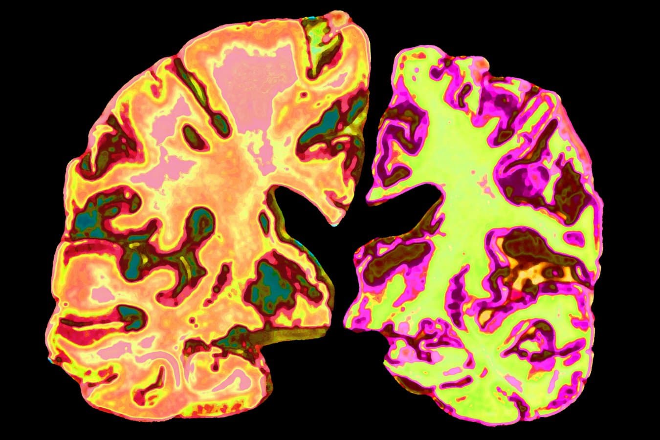 Should we all be taking low doses of lithium to prevent Alzheimer’s?