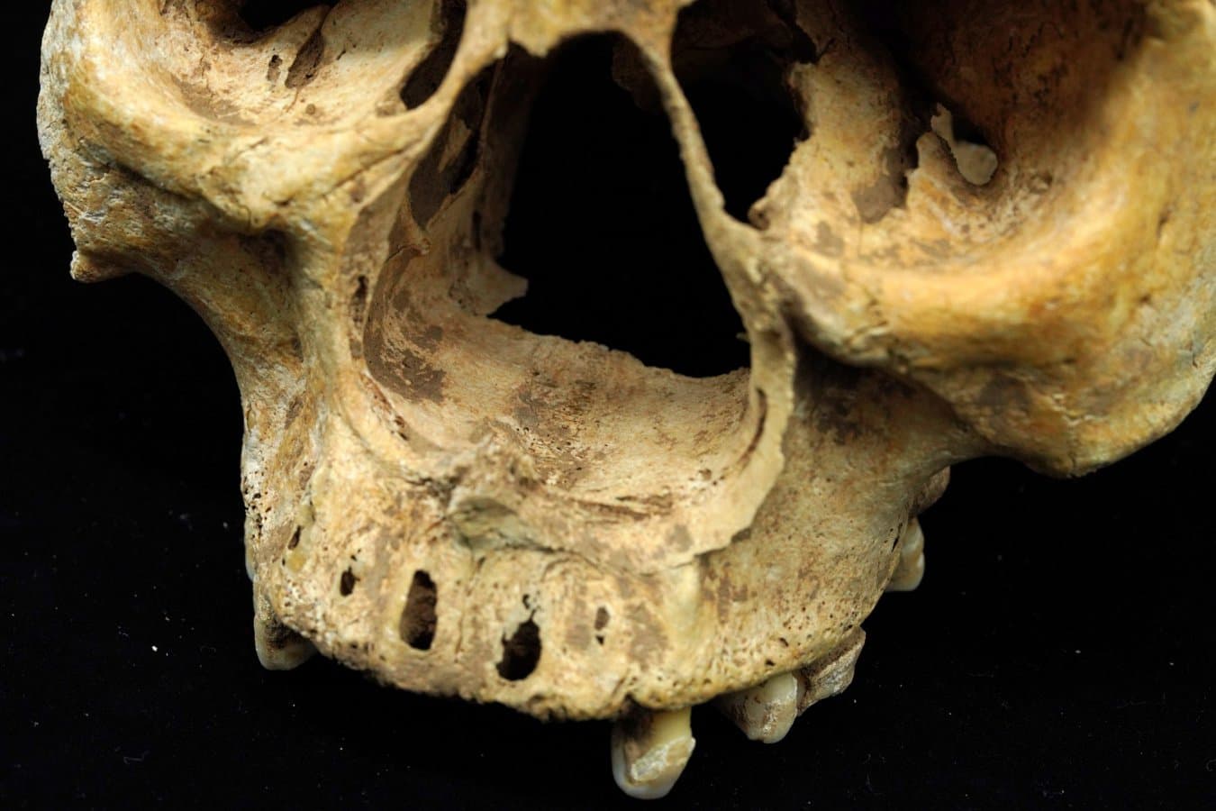 Ancient skeleton shows woman in imperial China had her nose amputated