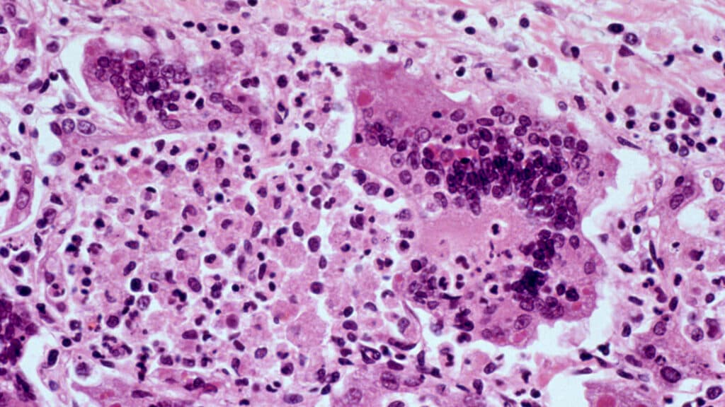 One of the most contagious diseases on the planet is having its worst U.S. outbreak since 1991
