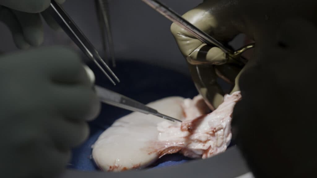 STAT+: Recipients of gene-edited pig kidneys successfully receive human organs