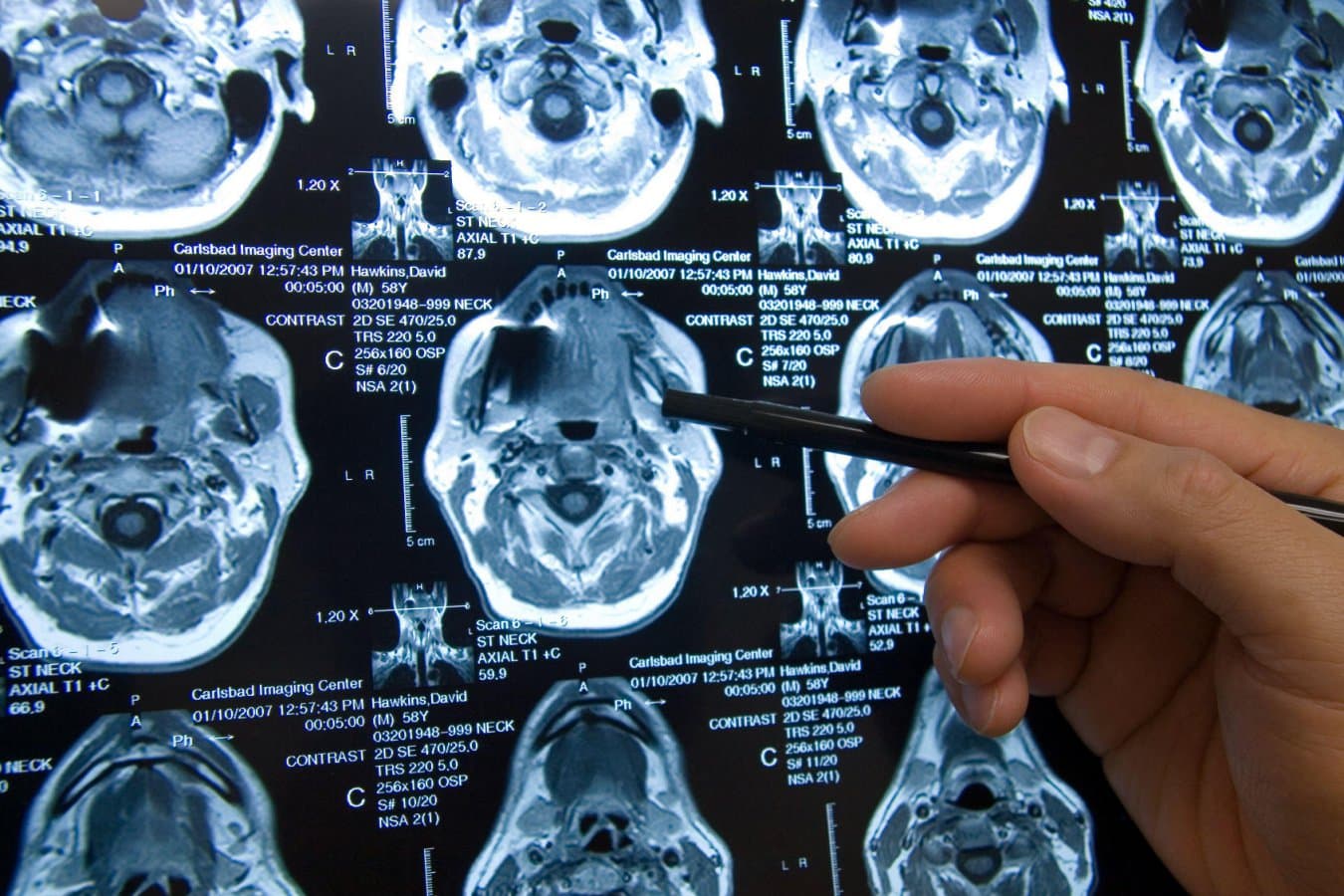 Depression doesn’t shrink the brain like we thought it did