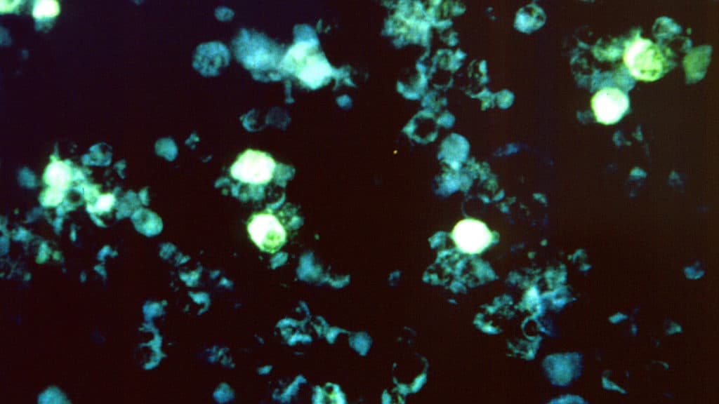 STAT+: New study untangles how Epstein-Barr viral infection triggers immune response in multiple sclerosis