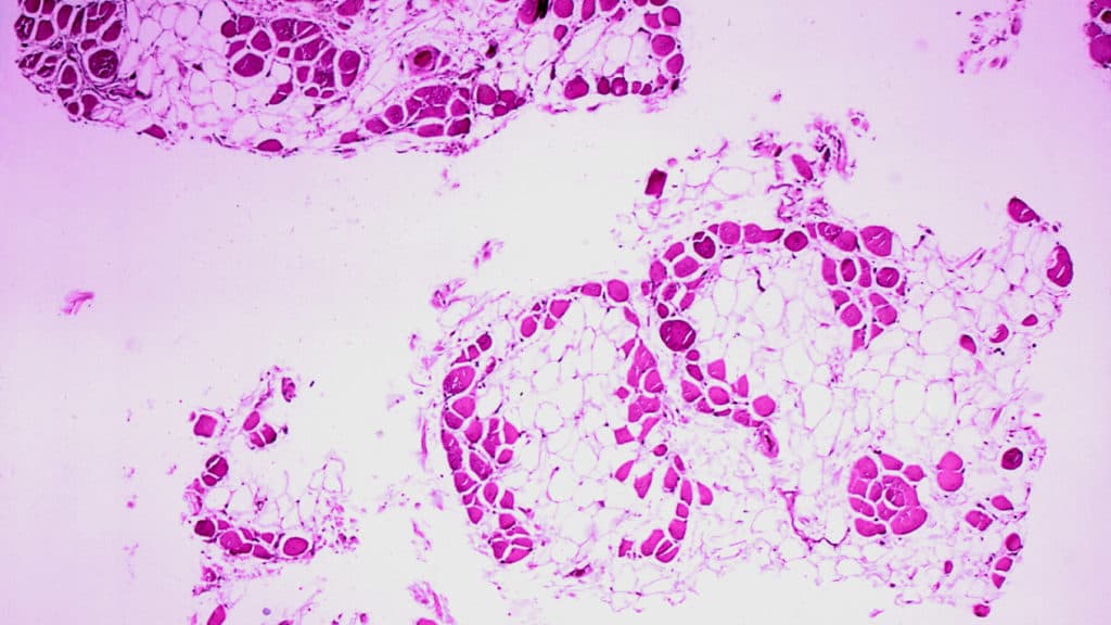 STAT+: FDA expert panel recommends against approval of Capricor’s Duchenne drug