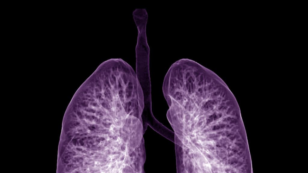 STAT+: Sionna’s experimental cystic fibrosis pill falls flat in mid-stage trial