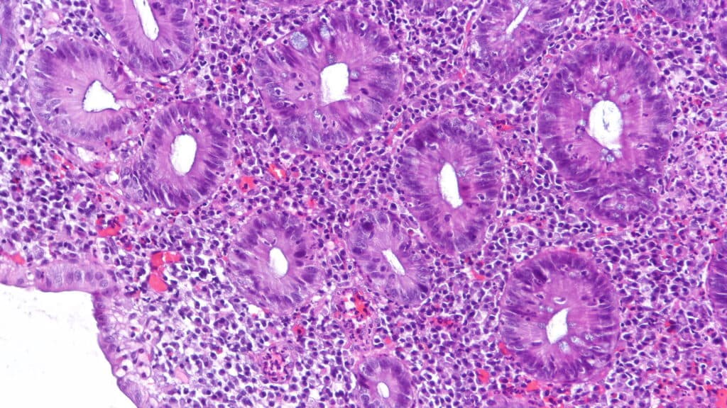 STAT+: Akero team, backed by Fairmount, launches new immunology company