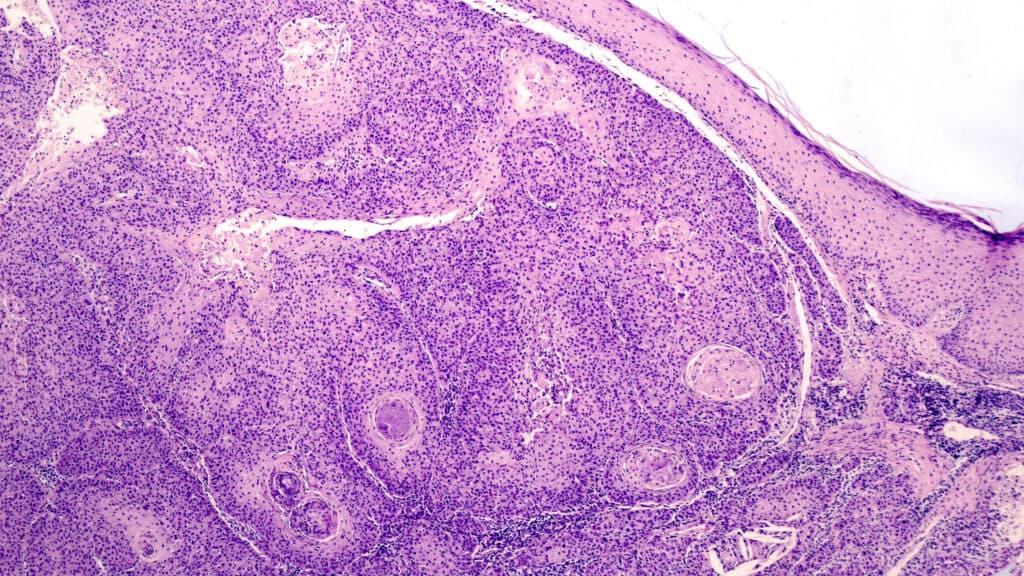 STAT+: FDA expert committee votes in favor of Replimune’s melanoma treatment