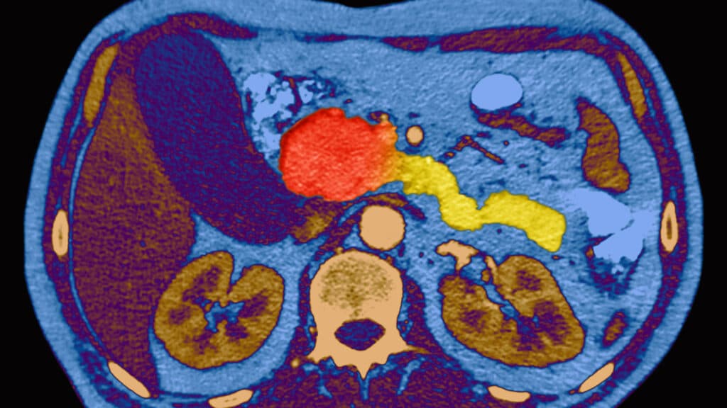 STAT+: A breakthrough in pancreatic cancer has experts excited — and braced for what’s to come