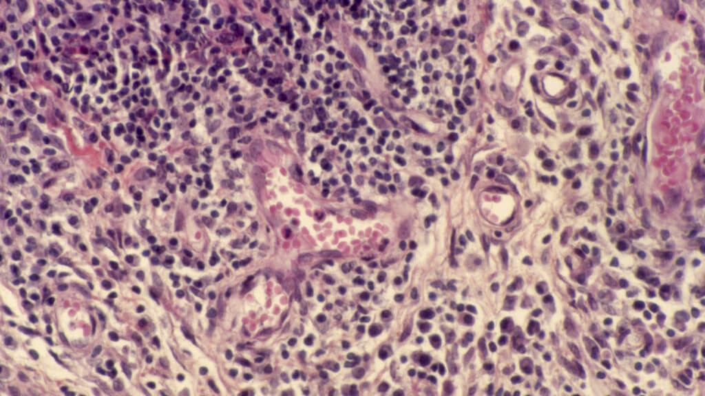 STAT+: After two deaths in autoimmune cell therapy trial, Artiva is shutting down